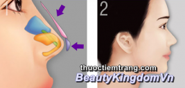 Phẫu thuật nâng mũi