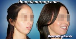 Phẫu thuật xương hàm chỉnh hô, móm, tạo mặt V line