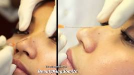 Nâng mũi không phẫu thuật bằng Filler