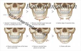 Bảng giá phẫu thuật thẩm mỹ xương hàm