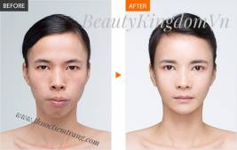 Bảng giá phẫu thuật thẩm mỹ vùng trán, má, cằm