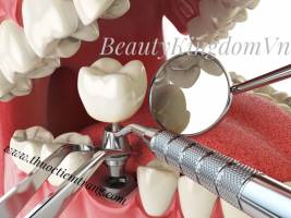Bảng giá làm răng Implant