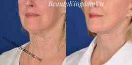 Căng da mặt, nâng cơ không phẫu thuật bằng chỉ sinh học collagen