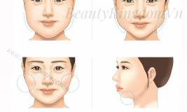 Phẫu thuật Hút Mỡ Mặt