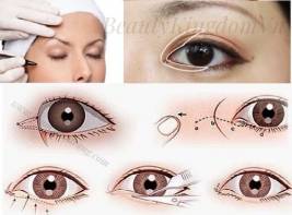 Phẫu thuật Thẩm Mỹ Mắt