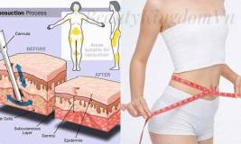 Phẫu thuật Hút Mỡ Bụng, Hút Mỡ Tứ Chi