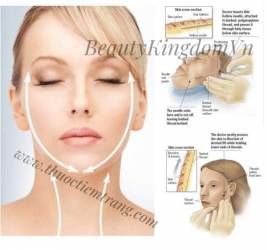 Diamond Cog Căng Chỉ Kim Cương trẻ hóa, giảm nhăn, chống đổ xệ, tăng sinh collagen
