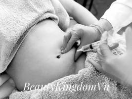 Liệu trình tiêm giảm béo vùng bụng MesoLipo