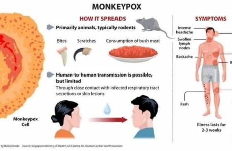 21/5 Một số điều cần biết về bệnh đậu mùa khỉ Monkeypox